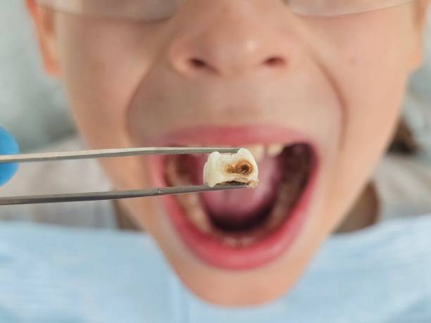 Best Cracked Tooth Emergency Dentist  in Montrose, NY